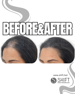 Scalp Micropigmentation for Density Camouflage for Women Turkey Before After SHIFT Hair Transplant in Istanbul 21 3