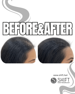 Scalp Micropigmentation for Density Camouflage for Women Turkey Before After SHIFT Hair Transplant in Istanbul 22 3