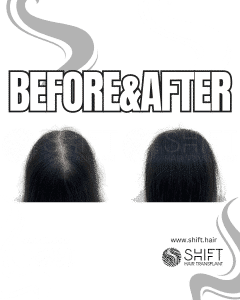 Scalp Micropigmentation for Density Camouflage for Women Turkey Before After SHIFT Hair Transplant in Istanbul 24 3