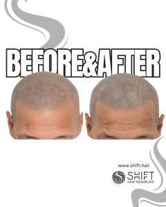 Scalp Micropigmentation for the Shaved Look Turkey Before After SHIFT Hair Transplant in Istanbul 22 3