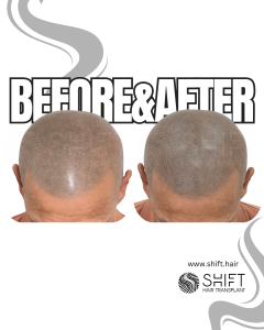 Scalp Micropigmentation for the Shaved Look Turkey Before After SHIFT Hair Transplant in Istanbul 23 3