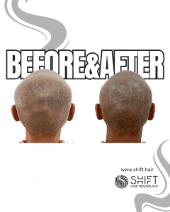 Scalp Micropigmentation for the Shaved Look Turkey Before After SHIFT Hair Transplant in Istanbul 24 3