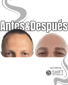 Antes Después de un trasplante de cejas para hombres en Turquía en SHIFT Hair en Estambul 04 3