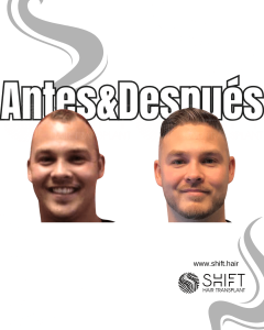 Antes y después de un trasplante capilar para la calvicie de Norwood 3 en Turquía en SHIFT Hair en Estambul 31 3