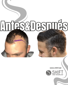 Antes y después de un trasplante capilar para la calvicie de Norwood 3 en Turquía en SHIFT Hair en Estambul 33 3