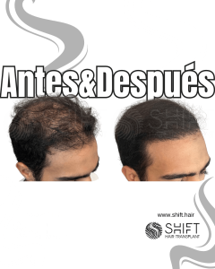 Antes y después de una micropigmentación capilar para un camuflaje de densidad en Turquía en SHIFT Hair en Estambul 93 3