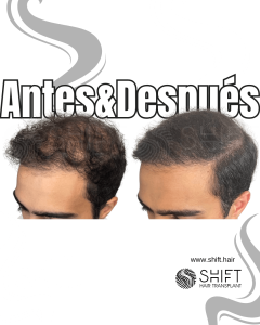 Antes y después de una micropigmentación capilar para un camuflaje de densidad en Turquía en SHIFT Hair en Estambul 94 3