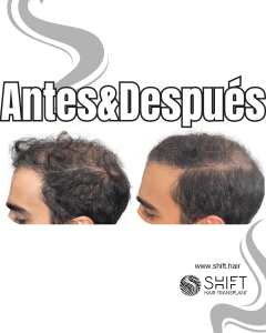 Antes y después de una micropigmentación capilar para un camuflaje de densidad en Turquía en SHIFT Hair en Estambul 96 3