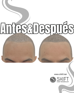Antes y después de una micropigmentación capilar para un look afeitado en Turquía en SHIFT Hair en Estambul 25 3