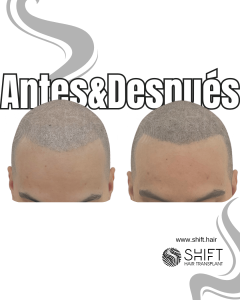 Antes y después de una micropigmentación capilar para un look afeitado en Turquía en SHIFT Hair en Estambul 26 3