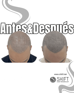 Antes y después de una micropigmentación capilar para un look afeitado en Turquía en SHIFT Hair en Estambul 27 3
