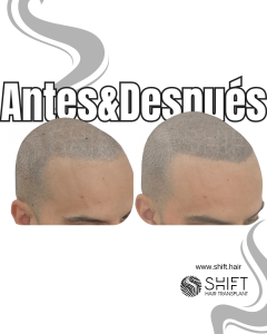Antes y después de una micropigmentación capilar para un look afeitado en Turquía en SHIFT Hair en Estambul 28 3