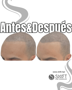 Antes y después de una micropigmentación capilar para un look afeitado en Turquía en SHIFT Hair en Estambul 29 3