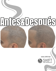 Antes y después de una micropigmentación capilar para un look afeitado en Turquía en SHIFT Hair en Estambul 31 3