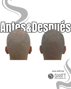 Antes y después de una micropigmentación capilar para un look afeitado en Turquía en SHIFT Hair en Estambul 34 3