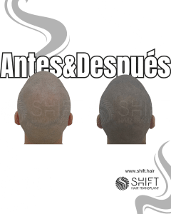 Antes y después de una micropigmentación capilar para un look afeitado en Turquía en SHIFT Hair en Estambul 35 3