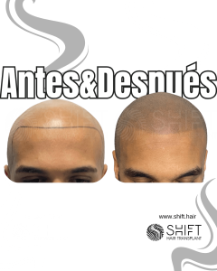 Antes y después de una micropigmentación capilar para un look afeitado en Turquía en SHIFT Hair en Estambul 36 3