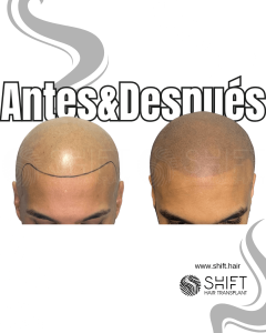 Antes y después de una micropigmentación capilar para un look afeitado en Turquía en SHIFT Hair en Estambul 37 3