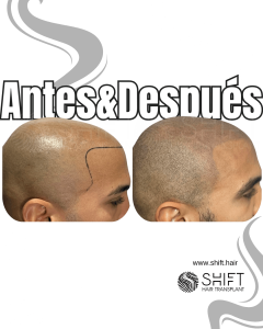 Antes y después de una micropigmentación capilar para un look afeitado en Turquía en SHIFT Hair en Estambul 41 3