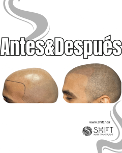 Antes y después de una micropigmentación capilar para un look afeitado en Turquía en SHIFT Hair en Estambul 42 3