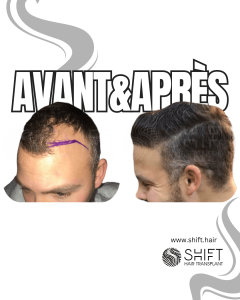 Avant Après de Greffe de Cheveux pour Calvitie Norwood 3 en Turquie chez SHIFT Hair à Istanbul 33 3