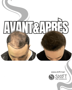 Avant Après de Greffe de Cheveux pour Calvitie Norwood 6 en Turquie chez SHIFT Hair à Istanbul 02 3