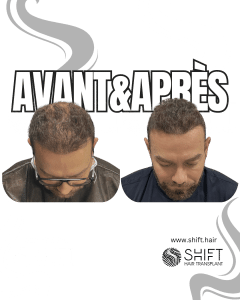 Avant Après de Greffe de Cheveux pour Calvitie Norwood 7 en Turquie chez SHIFT Hair à Istanbul 24 3
