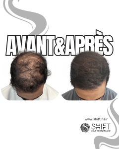 Avant Après de la micropigmentation du cuir chevelu pour le camouflage de densité en Turquie chez SHIFT Hair à Istanbul 92 3
