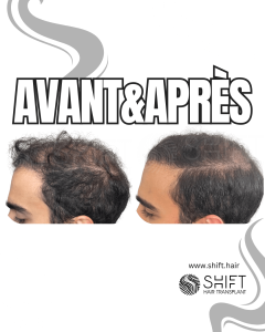 Avant Après de la micropigmentation du cuir chevelu pour le camouflage de densité en Turquie chez SHIFT Hair à Istanbul 96 3