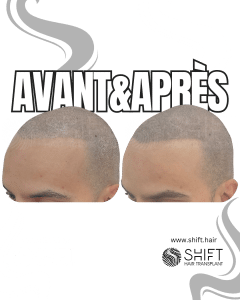 Avant Après de la micropigmentation du cuir chevelu pour un look rasé en Turquie chez SHIFT Hair à Istanbul 29 3
