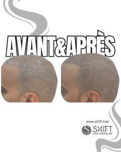 Avant Après de la micropigmentation du cuir chevelu pour un look rasé en Turquie chez SHIFT Hair à Istanbul 31 3