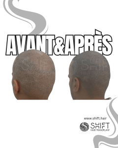 Avant Après de la micropigmentation du cuir chevelu pour un look rasé en Turquie chez SHIFT Hair à Istanbul 33 3