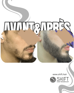 Avant Après une greffe de barbe en Turquie chez SHIFT Hair à Istanbul 23 3