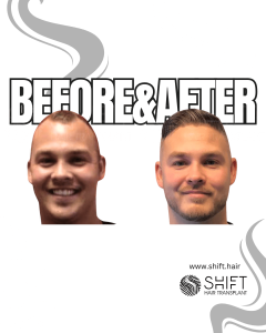 Hair Transplant Turkey Before After Norwood 3 Baldness SHIFT Hair Transplant in Istanbul 31 3