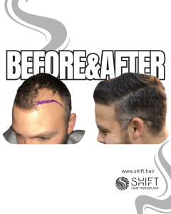 Hair Transplant Turkey Before After Norwood 3 Baldness SHIFT Hair Transplant in Istanbul 33 3