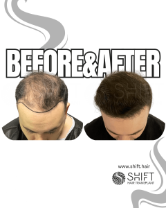 Hair Transplant Turkey Before After Norwood 6 Baldness SHIFT Hair Transplant in Istanbul 02 3