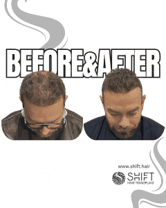 Hair Transplant Turkey Before After Norwood 7 Baldness SHIFT Hair Transplant in Istanbul 23 3