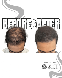 Scalp Micropigmentation for Density Camouflage Turkey Before After SHIFT Hair Transplant in Istanbul 91 3