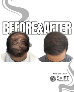 Scalp Micropigmentation for Density Camouflage Turkey Before After SHIFT Hair Transplant in Istanbul 92 3