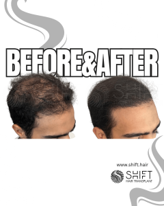 Scalp Micropigmentation for Density Camouflage Turkey Before After SHIFT Hair Transplant in Istanbul 93 3