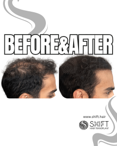 Scalp Micropigmentation for Density Camouflage Turkey Before After SHIFT Hair Transplant in Istanbul 95 3
