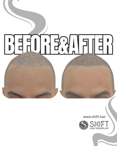 Scalp Micropigmentation for the Shaved Look Turkey Before After SHIFT Hair Transplant in Istanbul 25 3