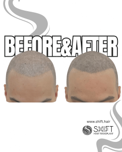 Scalp Micropigmentation for the Shaved Look Turkey Before After SHIFT Hair Transplant in Istanbul 26 3