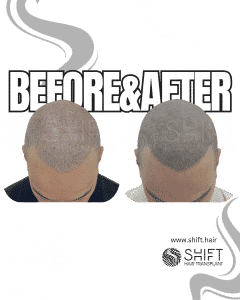 Scalp Micropigmentation for the Shaved Look Turkey Before After SHIFT Hair Transplant in Istanbul 27 3