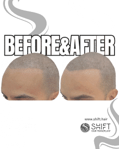 Scalp Micropigmentation for the Shaved Look Turkey Before After SHIFT Hair Transplant in Istanbul 29 3