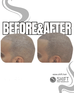 Scalp Micropigmentation for the Shaved Look Turkey Before After SHIFT Hair Transplant in Istanbul 31 3