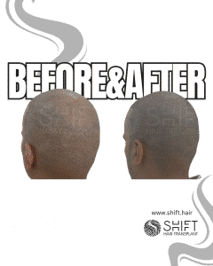 Scalp Micropigmentation for the Shaved Look Turkey Before After SHIFT Hair Transplant in Istanbul 33 3