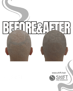 Scalp Micropigmentation for the Shaved Look Turkey Before After SHIFT Hair Transplant in Istanbul 34 3