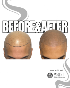Scalp Micropigmentation for the Shaved Look Turkey Before After SHIFT Hair Transplant in Istanbul 37 3