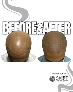 Scalp Micropigmentation for the Shaved Look Turkey Before After SHIFT Hair Transplant in Istanbul 38 3